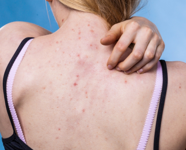 Điều Trị Mụn Lưng Tại Sen Beauty
